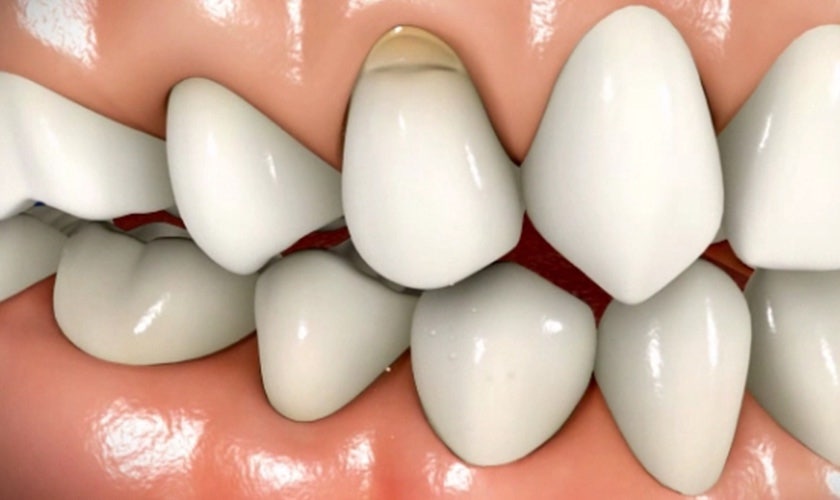 From Cavities to Chipped Front Teeth, Fast and Natural! image 6