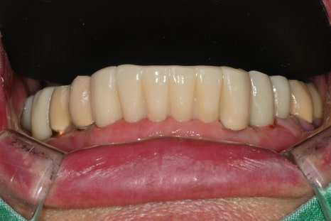 Immediate Implant Placement After Extraction! Seoulove Dental’s Fast Full-Mouth Implant Treatment Completed in 4 Months image 10