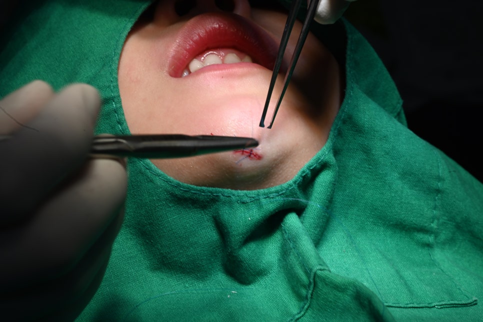 Pediatric Jaw Trauma: Can It Be Treated at a Dental Clinic Instead of a Plastic Surgery Clinic? See the Real Case image 3