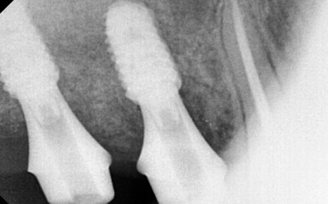 Songpa-gu Dental Clinic: Solving a Case Where Prosthetics Were Impossible with Implant Reoperation! image 10