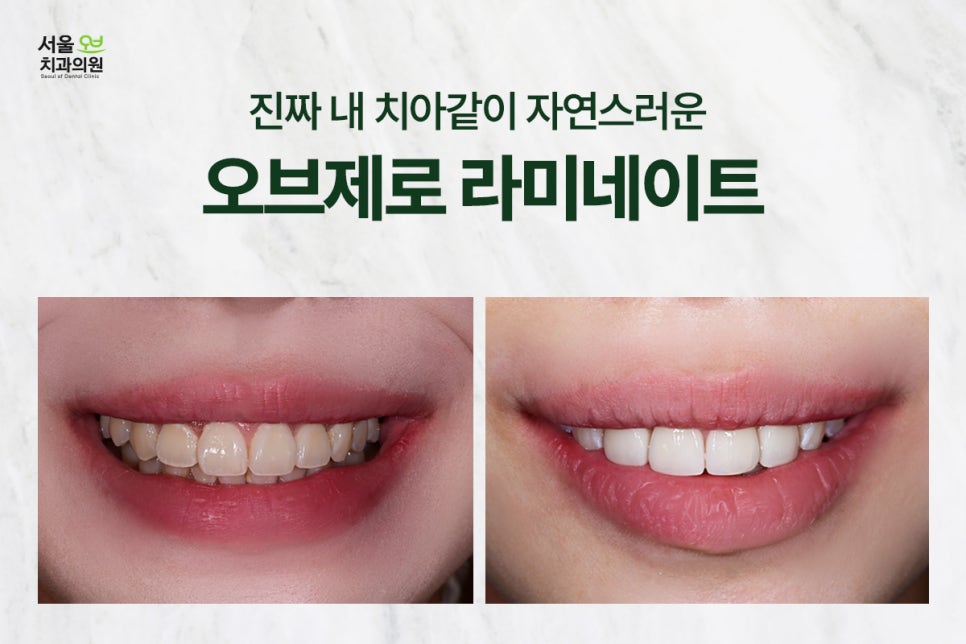 Objeo Laminate Cost, Treatment Review from a Woman in Her 20s image 31