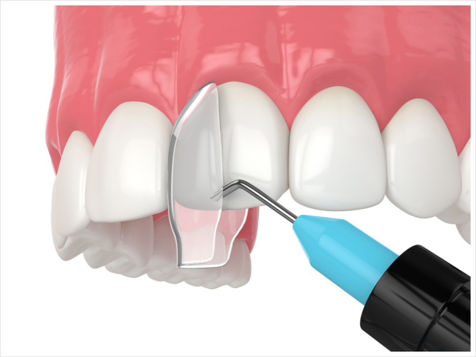 Concerned About Gaps Between Your Front Teeth? image 2