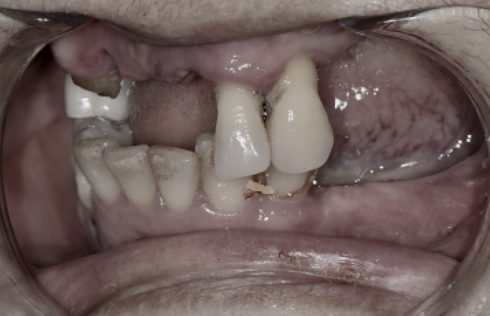 Full-Mouth Implant Price: Treatment Review of a Patient in Their 60s Who Restored Damaged Teeth image 7