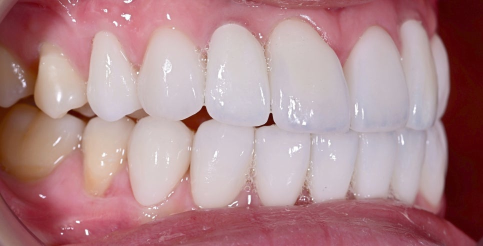 A Case of Simultaneous Laminate and Implant Prosthetic Treatment image 10