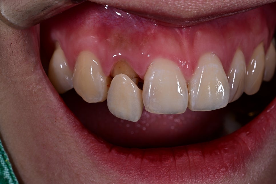 How We Naturally Improved an Upper Front Tooth Crown Retreatment, Including Color Differences and the Gum Line image 11