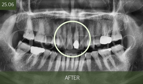 When Exactly Should Root Canal Treatment Be Done? image 3