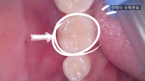 Inlay Treatment Review in Songpa-gu, Seoul – Completed in 1 Week with Precision Scanning and Lab Work image 6