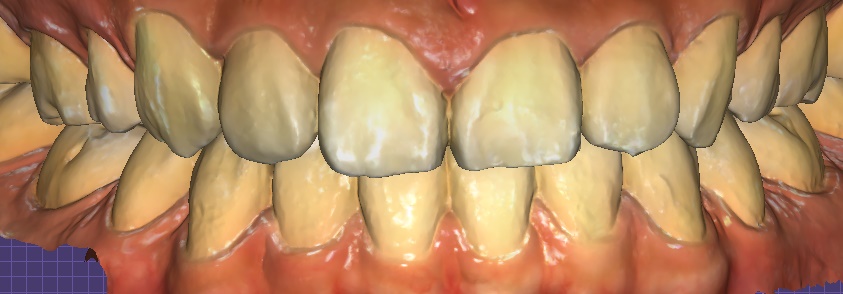 Samjeon Station Dental Clinic: "Without Orthodontics, Object Zero for the Smile Line of a Woman in Her 20s" image 6
