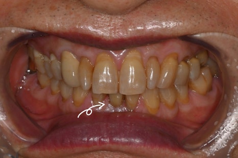 Implant Surgery and Precautions for Insurance Patients in Their 60s image 5