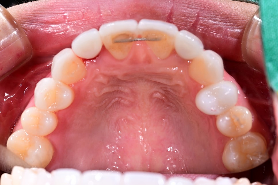 A Case of Simultaneous Laminate and Implant Prosthetic Treatment image 9