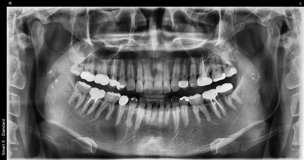 About Jawbone Benign Tumors and IV Sedation at Samjeon Station Dental Clinic image 1