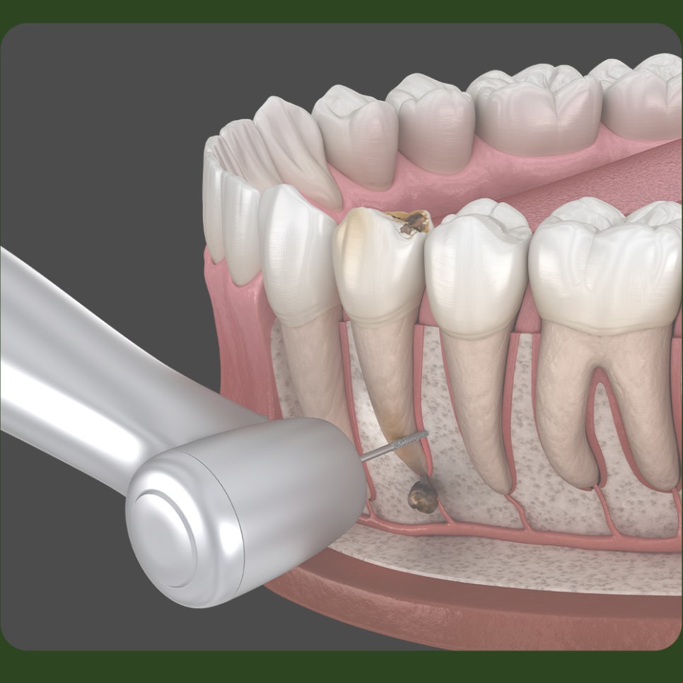치아 염증, 뿌리끝에 생겼다면? 관련 이미지 4