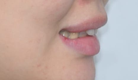 Jamsil Veneers: Worried About Rabbit Teeth? image 6