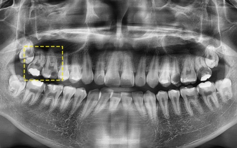 Samjeon Station Implant: Why do some break while others can last a lifetime? image 10