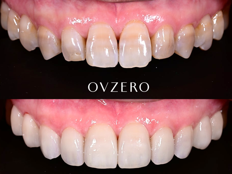 Objet Laminate Treatment for Seniors: Naturally Beautiful, Without Tooth Reduction image 16