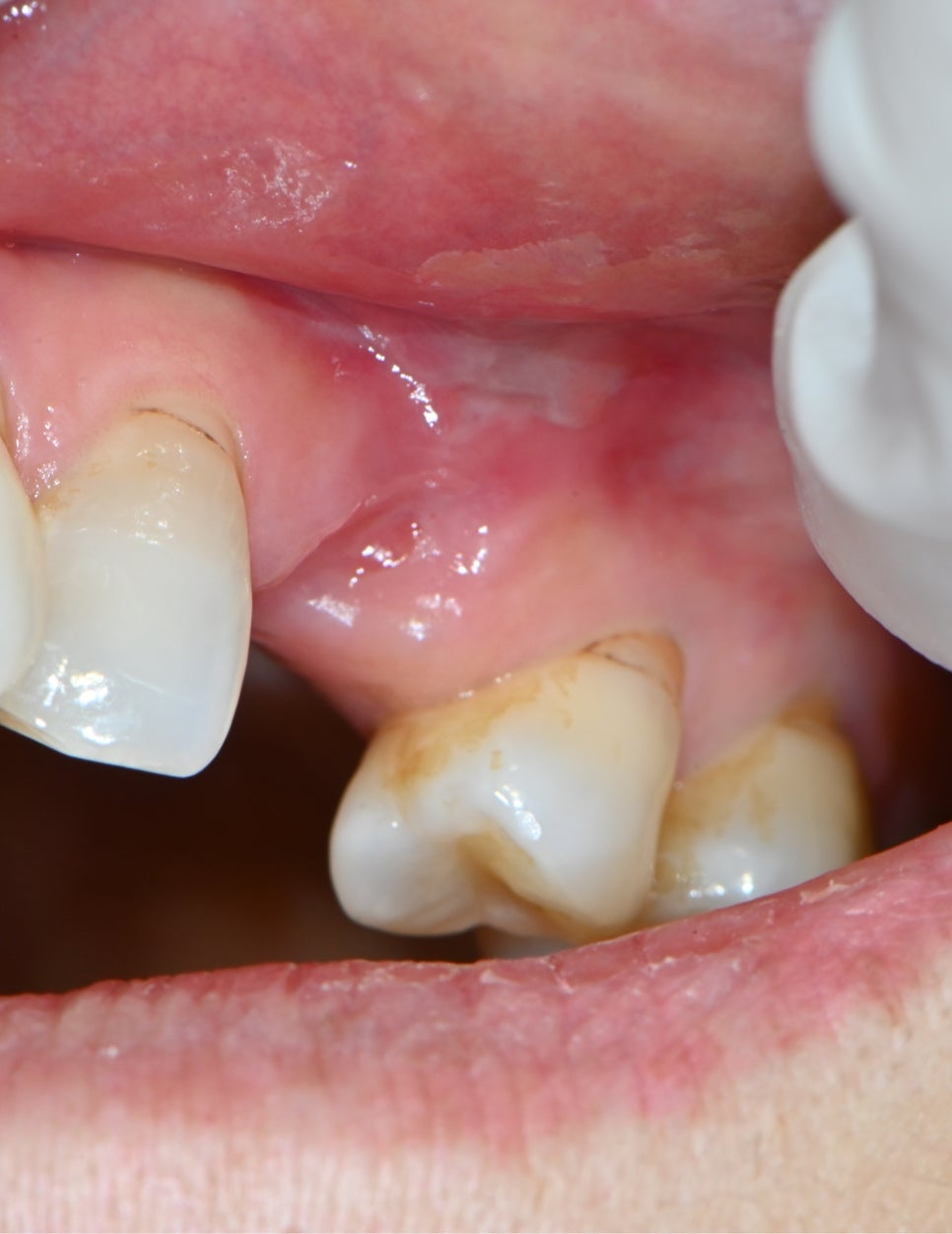 Songpa-gu Front Tooth Implant: Is It Possible Even in an Inflamed Area? image 4