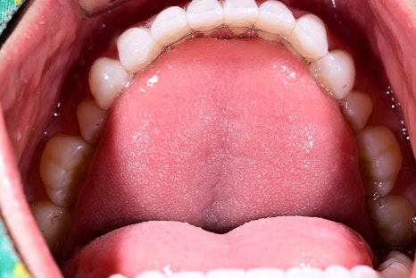 A Case of Simultaneous Laminate and Implant Prosthetic Treatment image 5