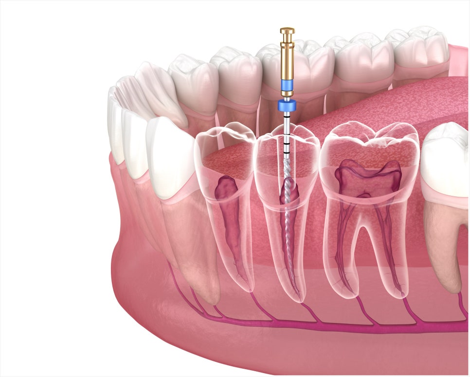 Why Is a Crown Placed After Root Canal Treatment? image 3