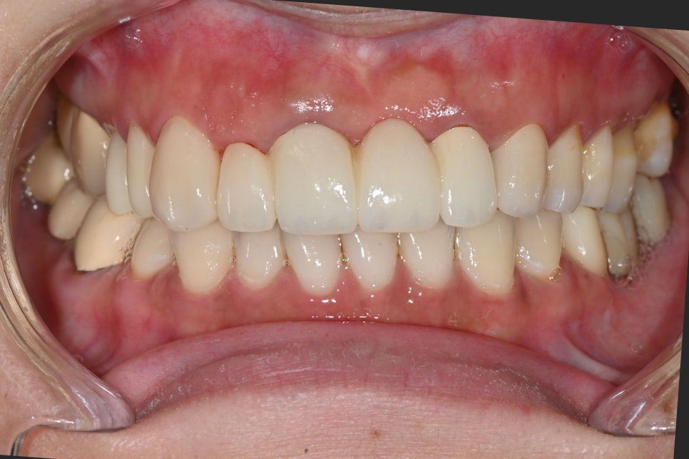 오브제로라미네이트, 무삭제라미네이트 자연스럽게 가능할까?(OVZERO Veneers, Is No-Prep Veneer Really Possible?) 관련 이미지 12