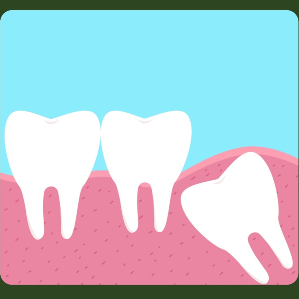 After Wisdom Tooth Extraction, Can I Exercise Right Away? image 5