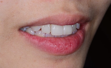 Laminate Veneers for Protruding Teeth: If They’re Too Thick, They Look Even More Prominent image 2