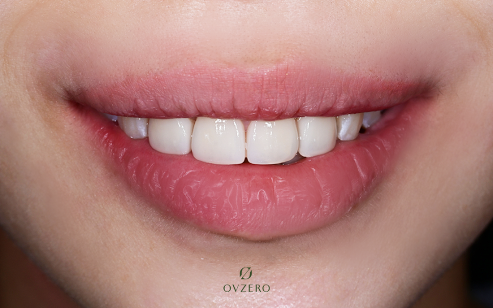 Objeo Laminate Cost, Treatment Review from a Woman in Her 20s image 9