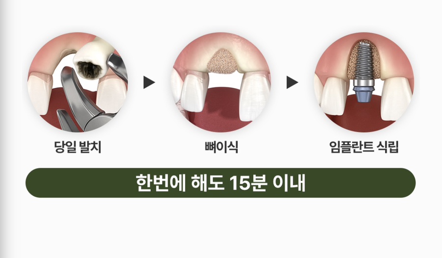 A 90s Senior Who Was Curious About Implant Insurance Pricing: How Did the Treatment Proceed? image 11