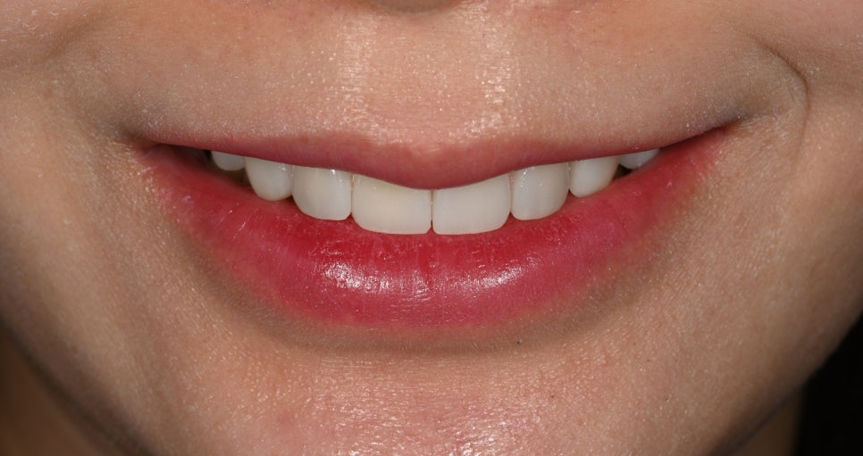 Tooth Wear: Resin? Veneers Are Also an Option image 8