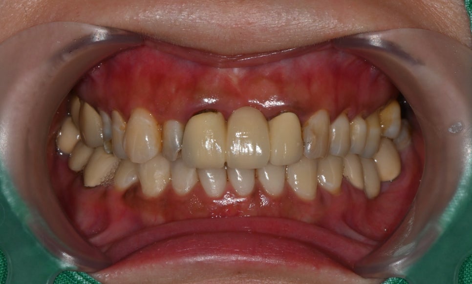 오브제로라미네이트, 무삭제라미네이트 자연스럽게 가능할까?(OVZERO Veneers, Is No-Prep Veneer Really Possible?) 관련 이미지 8