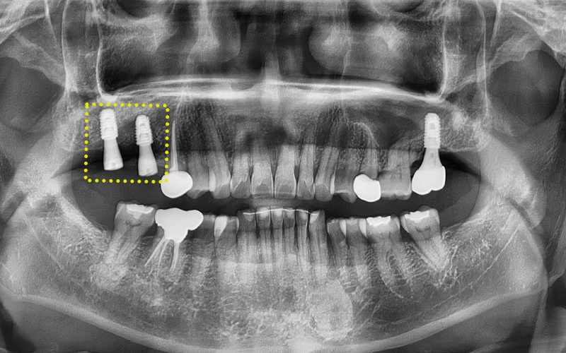 Songpa-gu Dental Clinic: Solving a Case Where Prosthetics Were Impossible with Implant Reoperation! image 8
