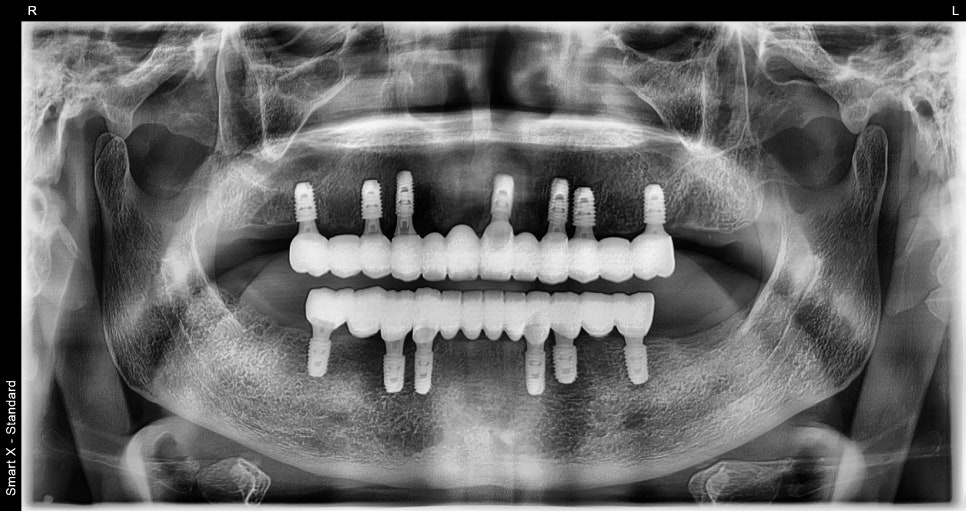 Full-Mouth Implant Price: Treatment for a Patient Over 65 Performed Under Sedation image 10