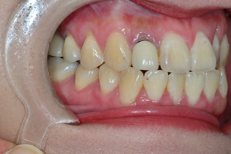 How We Naturally Improved an Upper Front Tooth Crown Retreatment, Including Color Differences and the Gum Line image 3