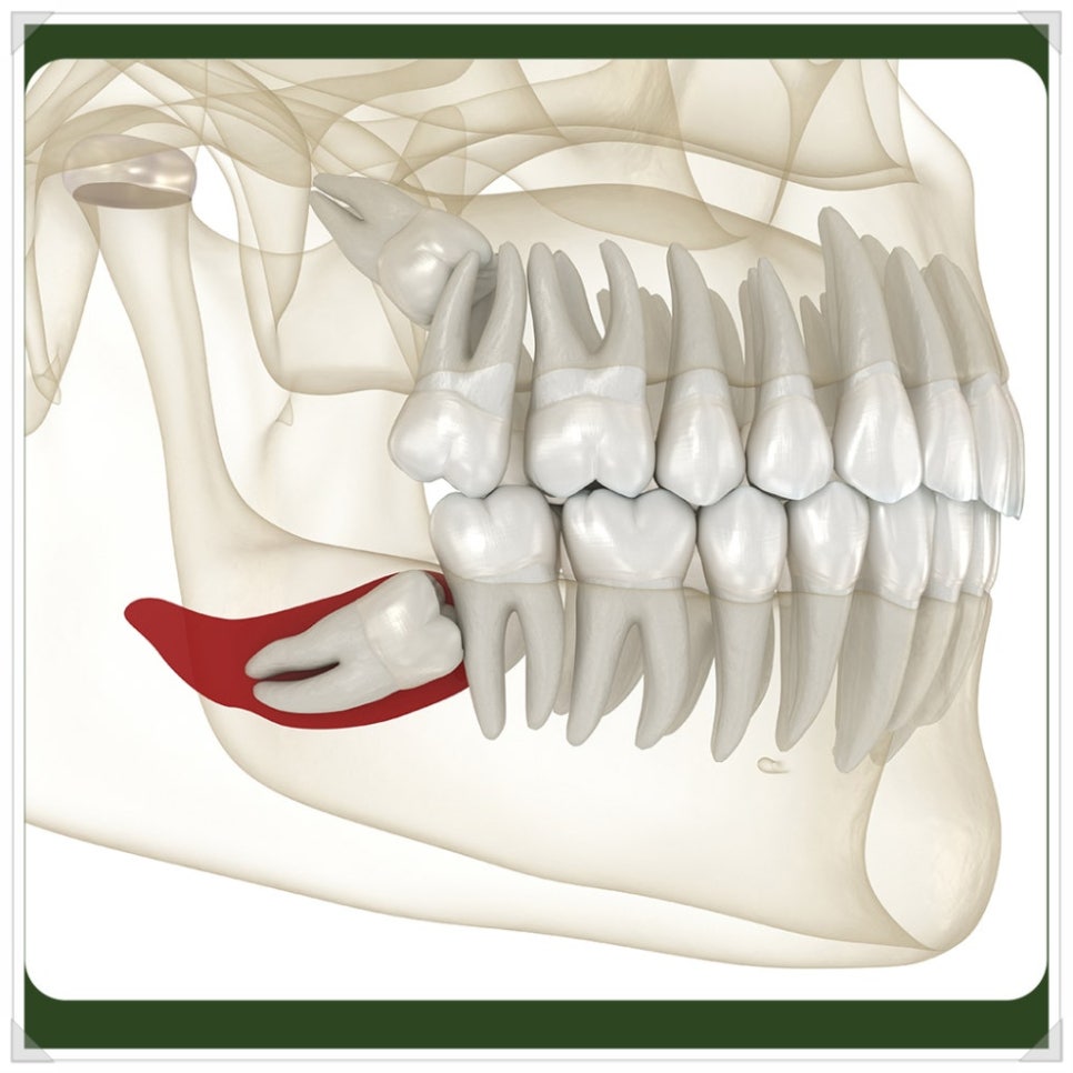 Wisdom Tooth Inflammation: Don’t Leave It Alone—Please Have It Removed! image 4