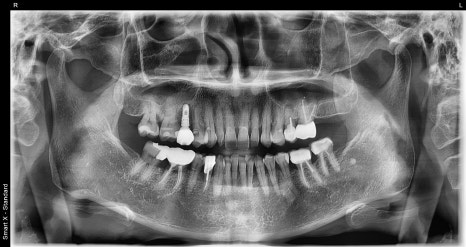 Is an Implant Price Really Worth Trusting? image 5