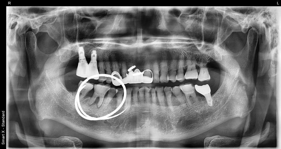 Understanding Implant Price Differences Through the Molar Implant Process image 3