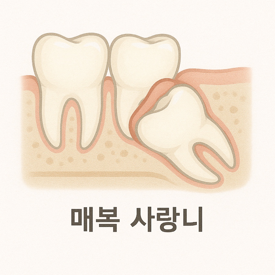 How to Care for Your Mouth After Wisdom Tooth Extraction image 5