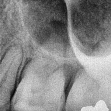 어금니 임플란트가격, 임플란트치과에서 진행한 실제 치료 과정
