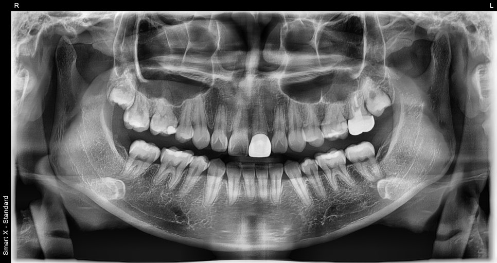 Rabbit Teeth Veneers: Treatment to Achieve Natural Front-Tooth Proportions image 1