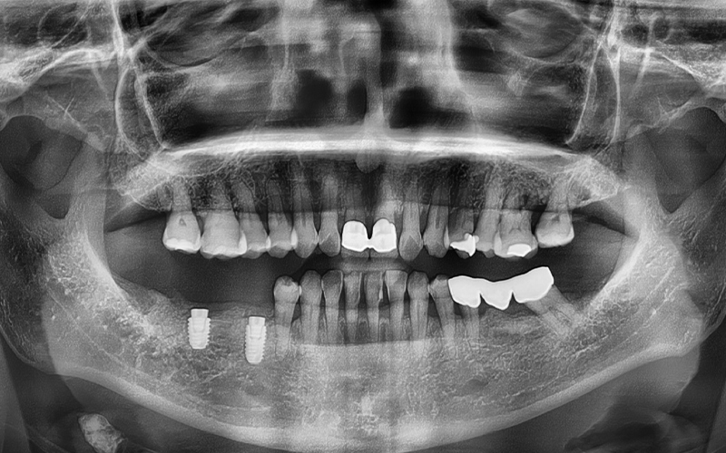 [Seokchon Gobun Station Dental Clinic] When Is an Implant Needed? image 5