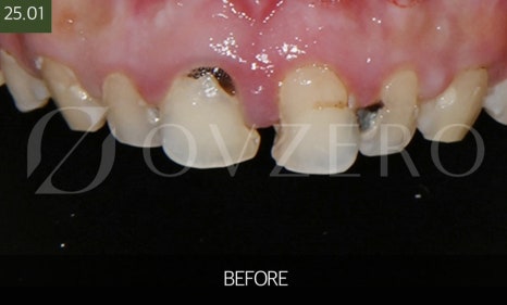 Jamsil Dental Clinic Zirconia Crown Price image 4