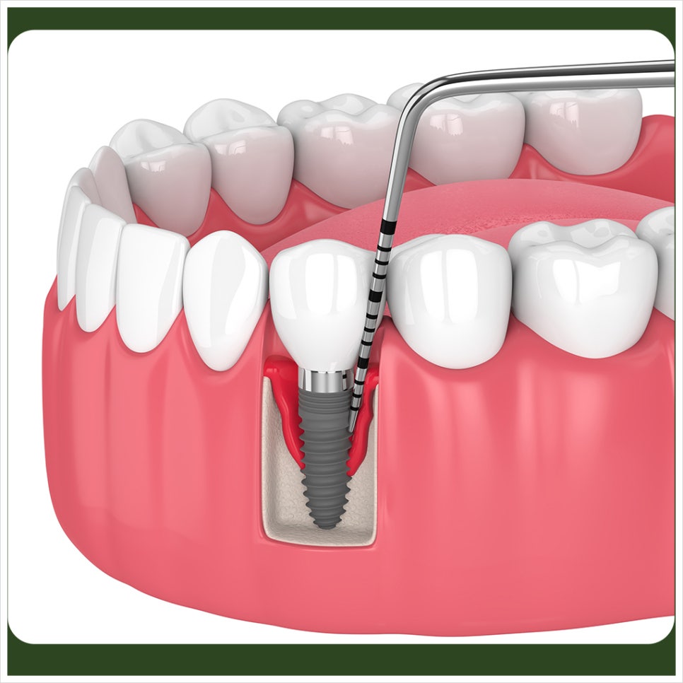 What Should You Do If You Notice Odor After an Implant? image 4