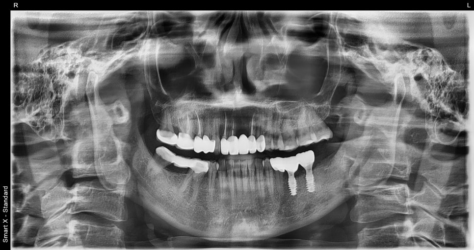 오브제로라미네이트, 무삭제라미네이트 자연스럽게 가능할까?(OVZERO Veneers, Is No-Prep Veneer Really Possible?) 관련 이미지 11