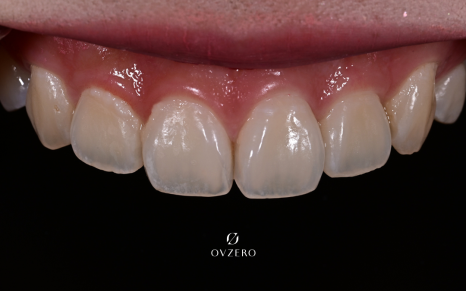 Objeo Laminate Cost, Treatment Review from a Woman in Her 20s image 4