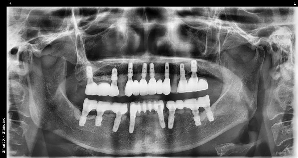 앞니 임플란트, 전치부 심미까지 살린 치료 과정 정리 관련 이미지 20