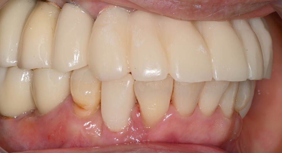 Full-Mouth Implant Price: Treatment Review of a Patient in Their 60s Who Restored Damaged Teeth image 10