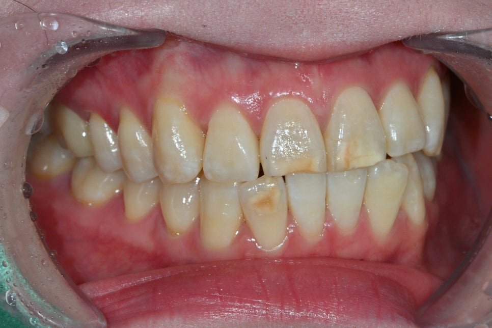 Songpa Dental Clinic: A Case of Improving Mottled Teeth with Veneers image 4
