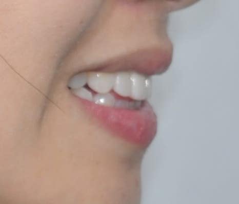 Laminate Veneers for Protruding Teeth: If They’re Too Thick, They Look Even More Prominent image 15