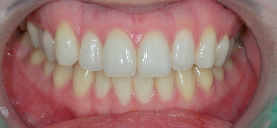 Canine Veneers Without Orthodontic Treatment image 2