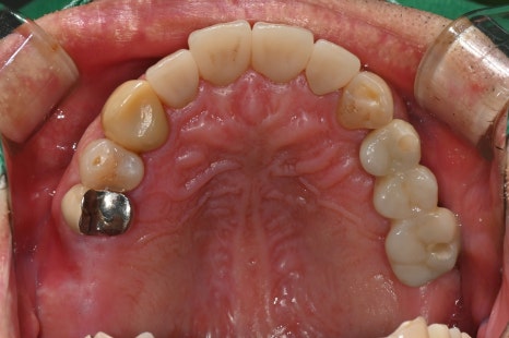 A Broken Front Tooth from a Fall, Restored Along with the Gums! Emergency Treatment Report from Seoul Ob Dental Hospital image 9