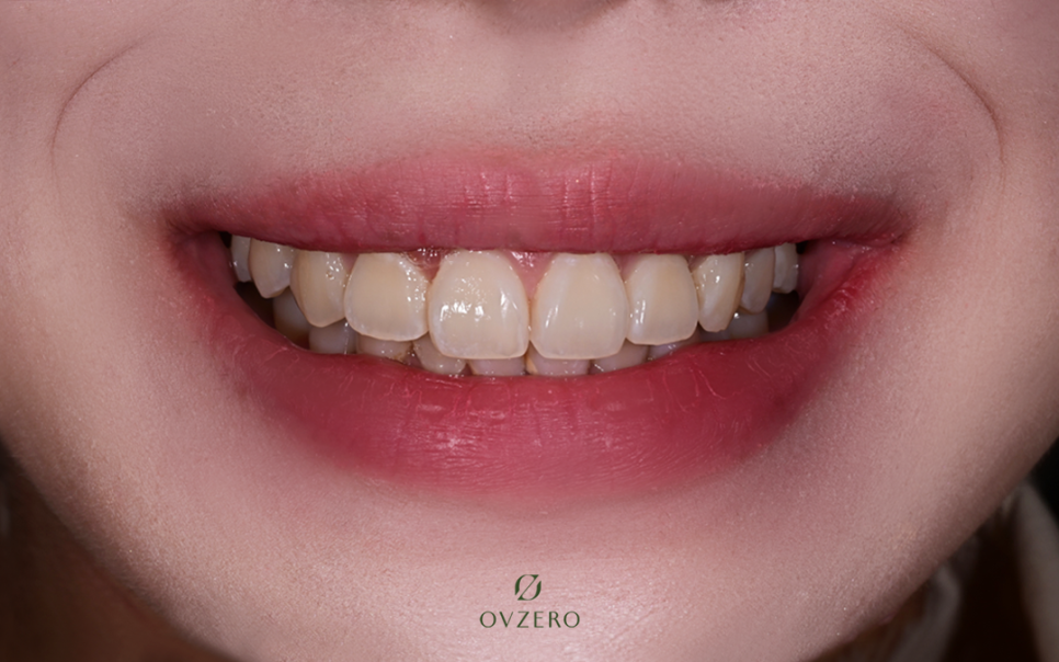 Objeo Laminate Cost, Treatment Review from a Woman in Her 20s image 6